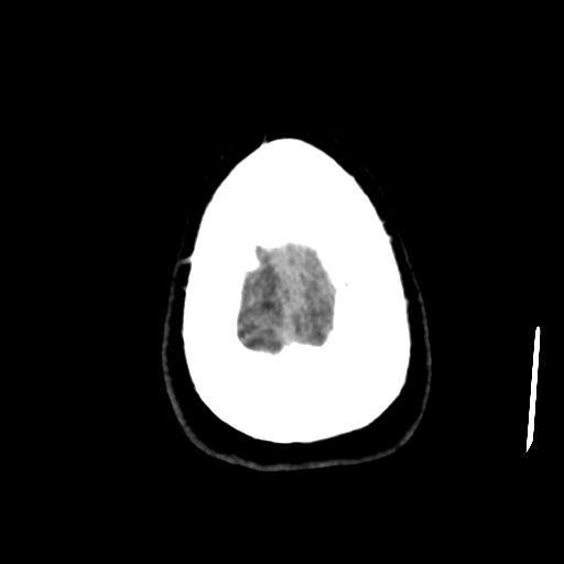Cerebral abscess (Radiopaedia 29451-29919 Axial non-contrast 47).jpg