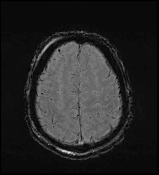 Cerebral abscess with ventriculitis (Radiopaedia 78965-91878 Axial SWI 42).jpg