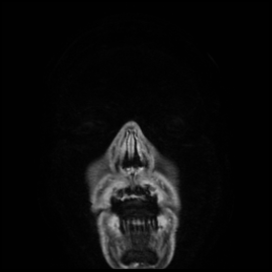 Cerebral abscess with ventriculitis (Radiopaedia 78965-91878 Coronal T1 C+ 1).jpg