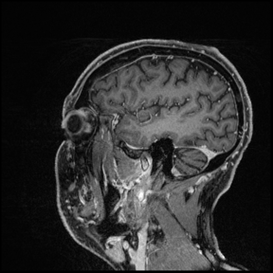 Cerebral abscess with ventriculitis (Radiopaedia 78965-91878 Sagittal T1 C+ 141).jpg