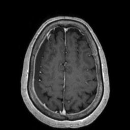 File:Cerebral amyloid angiopathy (Radiopaedia 29129-29518 Axial T1 C+ 117).jpg
