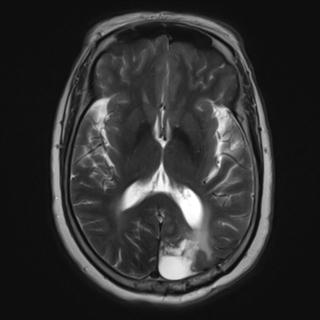 File:Cerebral amyloid angiopathy (Radiopaedia 29129-29518 Axial T2 11).jpg