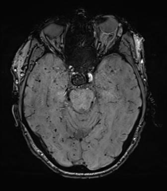 File:Cerebral amyloid angiopathy (Radiopaedia 46082-50433 Axial SWI 29).png