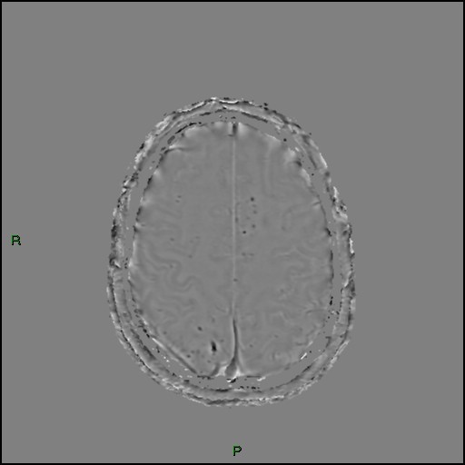 Cerebral amyloid angiopathy (Radiopaedia 77506-89664 H 81).jpg