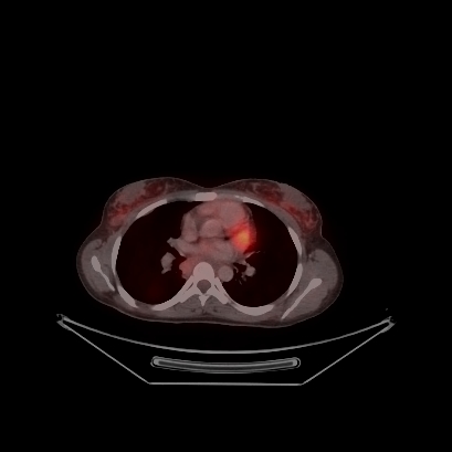 Cerebral and abdominal tuberculosis (Radiopaedia 90499-107853 C 101).jpg