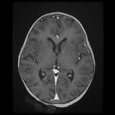 Cerebral and spinal tuberculosis (Radiopaedia 90489-107837 Axial T1 C+ 105).jpg