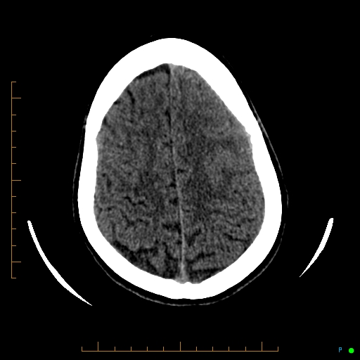 Cerebral arteriovenous malformation (AVM) (Radiopaedia 78162-90706 Axial non-contrast 51).jpg