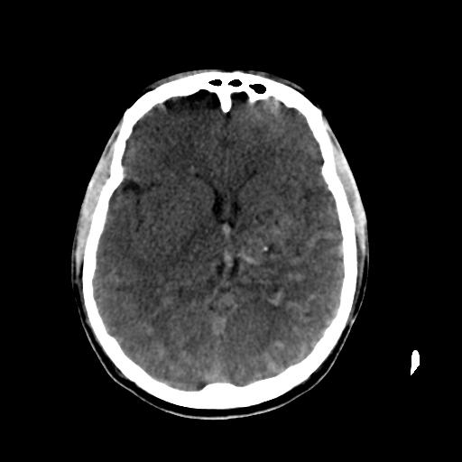 Cerebral arteriovenous malformation (Radiopaedia 28518-28759 Axial non-contrast 36).jpg