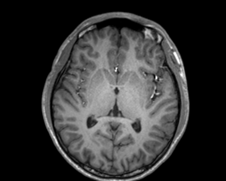 Cerebral arteriovenous malformation (Radiopaedia 30198-30813 Axial T1 33).jpg