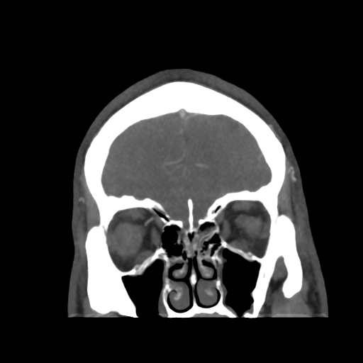 Cerebral arteriovenous malformation (Radiopaedia 39259-41505 E 12).png
