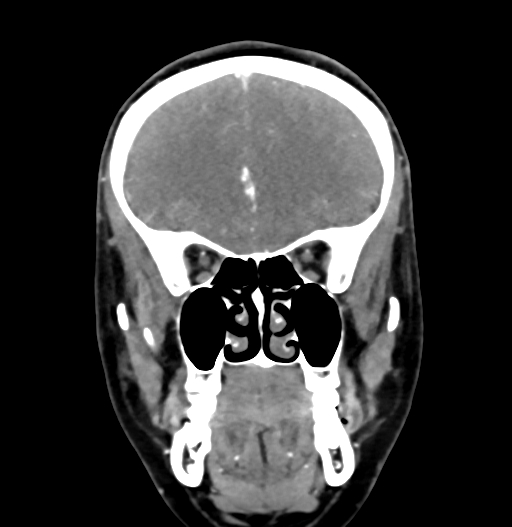 Cerebral arteriovenous malformation (Radiopaedia 73830-84645 C 28).jpg