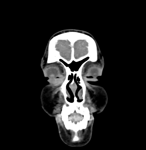 Cerebral arteriovenous malformation (Radiopaedia 73830-84645 C 9).jpg