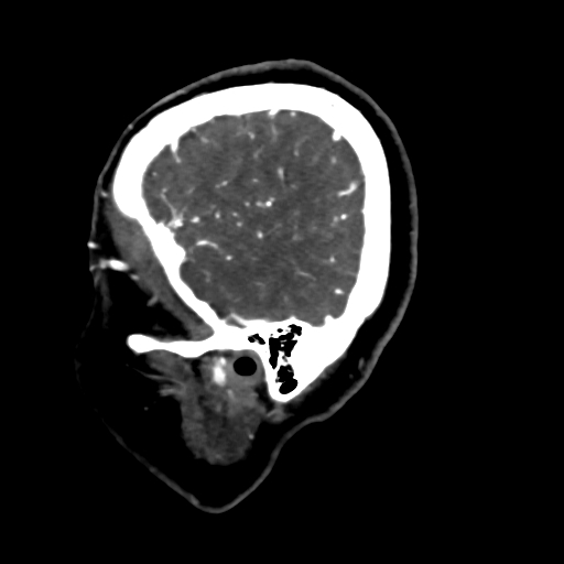 File:Cerebral arteriovenous malformation (Radiopaedia 73830-84645 Sagittal C+ delayed 11).jpg