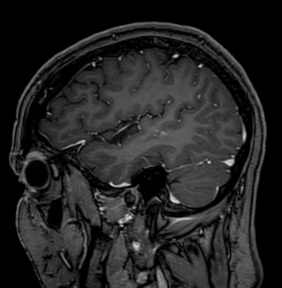 Cerebral arteriovenous malformation (Radiopaedia 74411-85746 Sagittal T1 C+ 24).jpg
