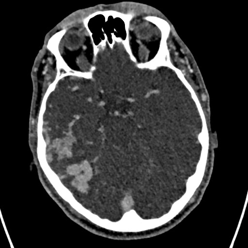 Cerebral arteriovenous malformation (Radiopaedia 78188-90746 Axial C+ delayed 65).jpg