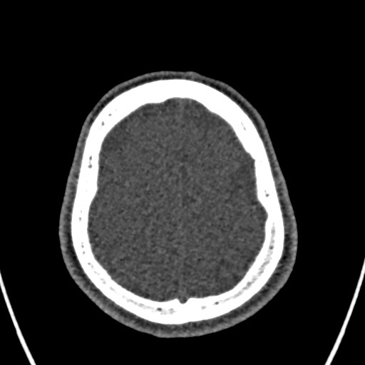 File:Cerebral arteriovenous malformation (Radiopaedia 78188-90746 Axial non-contrast 150).jpg