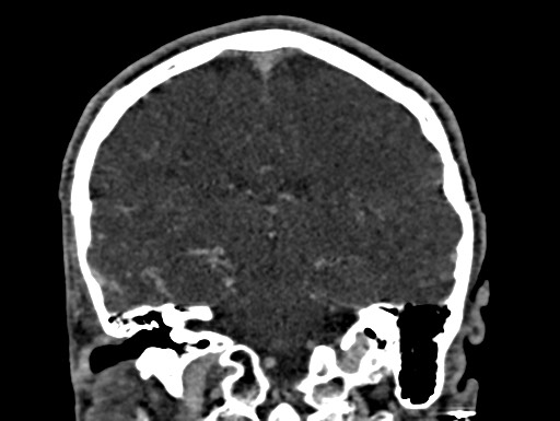 Cerebral arteriovenous malformation (Radiopaedia 78188-90746 Coronal C+ delayed 70).jpg