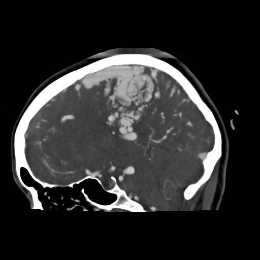 File:Cerebral arteriovenous malformation (Radiopaedia 79677-92888 C 20).jpg