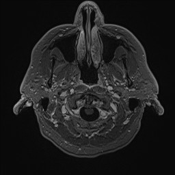 Cerebral arteriovenous malformation (Radiopaedia 84015-99245 Axial T1 C+ 14).jpg