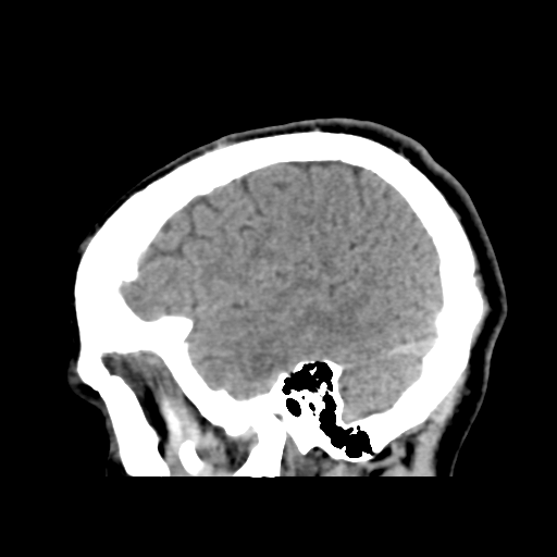 Cerebral arteriovenous malformation (Spetzler-Martin grade 2) (Radiopaedia 41262-44076 A 16).png