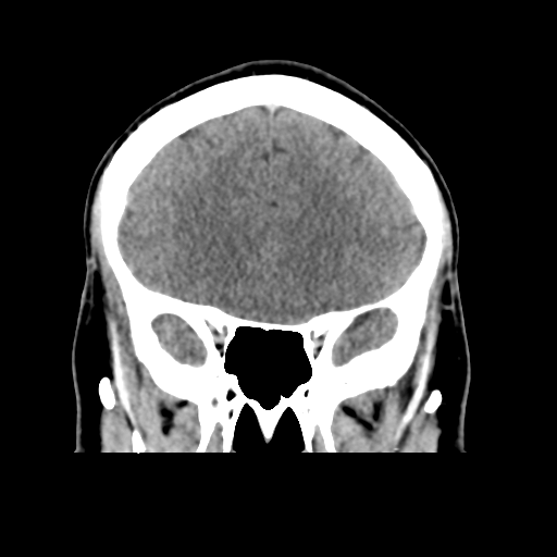 Cerebral arteriovenous malformation (Spetzler-Martin grade 2) (Radiopaedia 41262-44076 Coronal non-contrast 19).png
