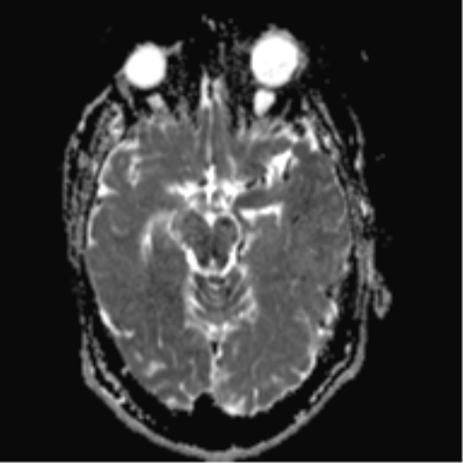 File:Cerebral arteriovenous malformation - huge (Radiopaedia 35734-37272 Axial ADC 9).png