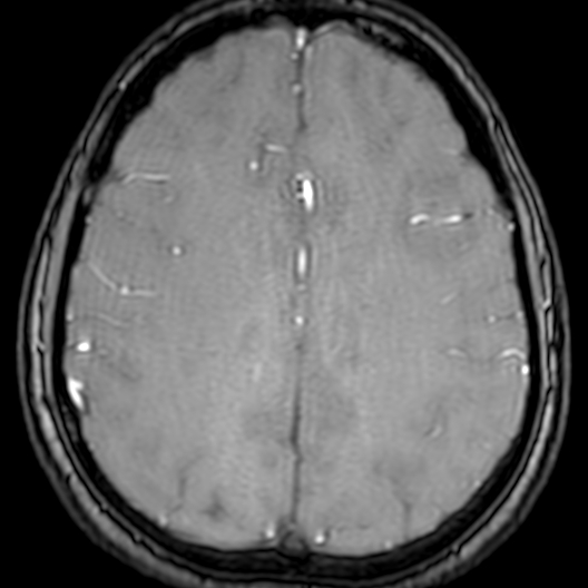 Cerebral arteriovenous malformation at posterior body of corpus callosum (Radiopaedia 74111-84925 Axial MRA 155).jpg
