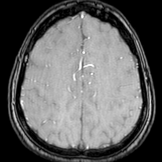 Cerebral arteriovenous malformation at posterior body of corpus callosum (Radiopaedia 74111-84925 Axial MRA 169).jpg