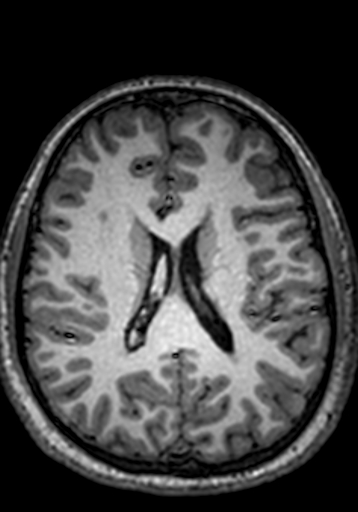 Cerebral arteriovenous malformation at posterior body of corpus callosum (Radiopaedia 74111-84925 Axial T1 112).jpg