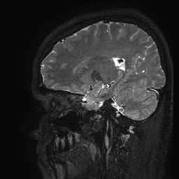 Cerebral arteriovenous malformation at posterior body of corpus callosum (Radiopaedia 74111-84925 Sagittal T2 88).jpg