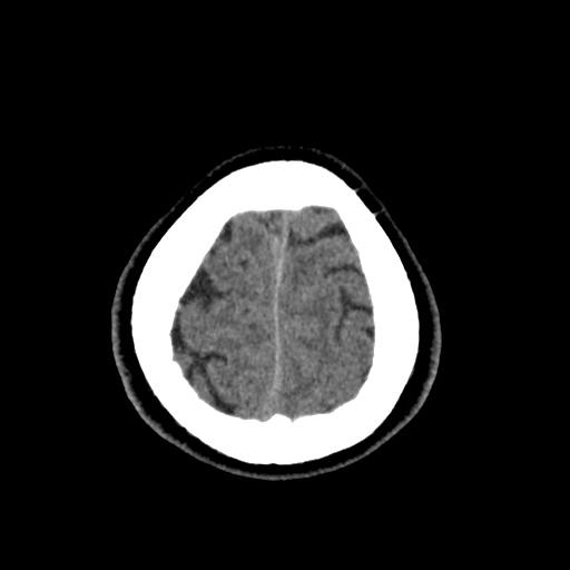 Cerebral arteriovenous malformation with lobar hemorrhage (Radiopaedia 35598-37117 Axial non-contrast 51).jpg