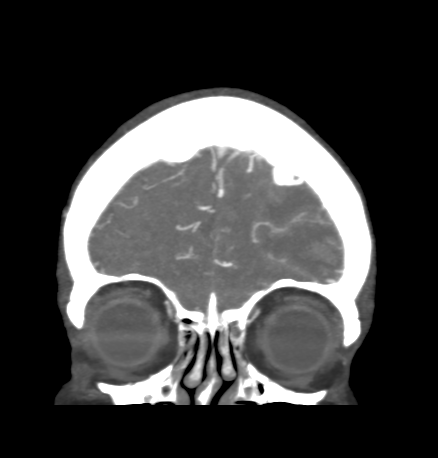 File:Cerebral arteriovenous malformation with lobar hemorrhage (Radiopaedia 44725-48511 B 10).png