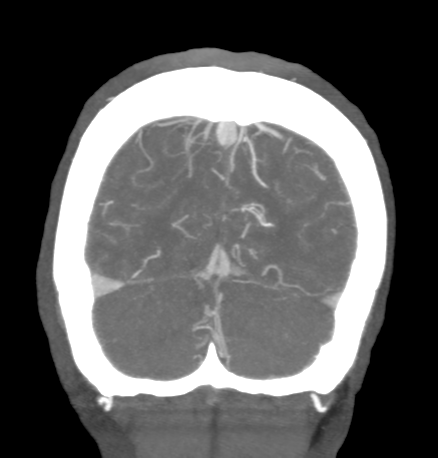 Cerebral arteriovenous malformation with lobar hemorrhage (Radiopaedia 44725-48511 B 49).png