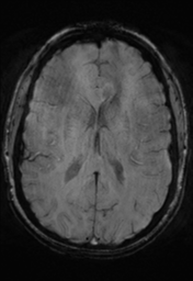 File:Cerebral cavernoma and development venous anomaly (Radiopaedia 37603-39482 Axial SWI 23).png