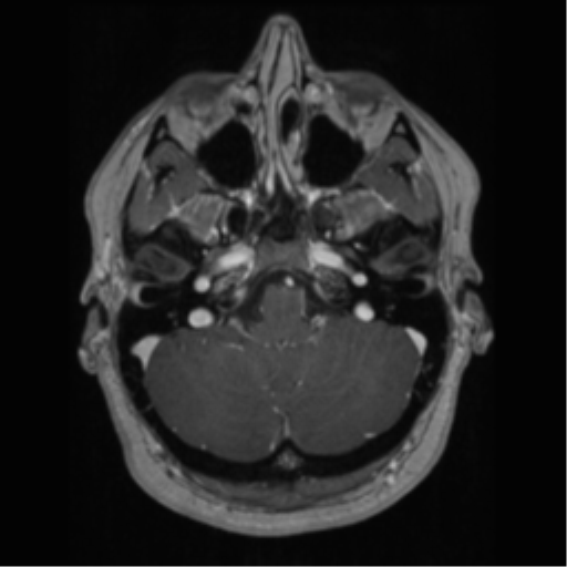Cerebral cavernoma and development venous anomaly (Radiopaedia 37603-39482 Axial T1 C+ 17).png
