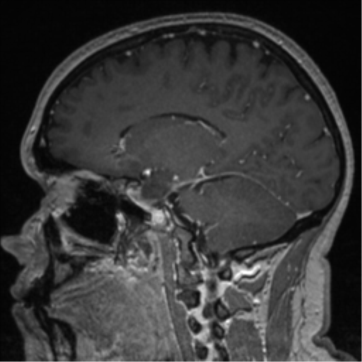 File:Cerebral cavernoma and development venous anomaly (Radiopaedia 37603-39482 Sagittal T1 C+ 41).png