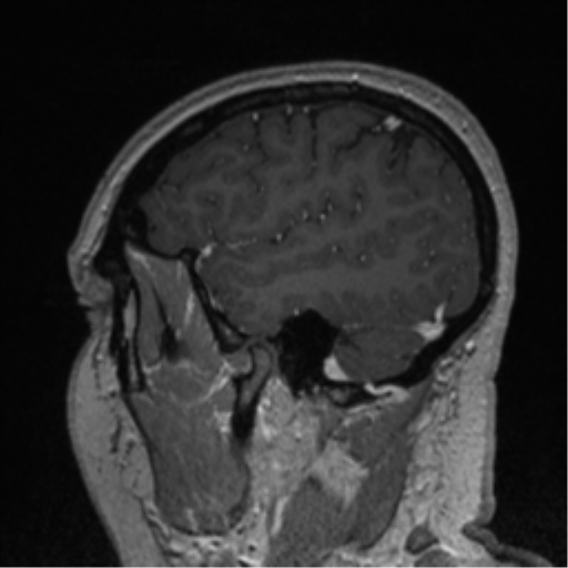 Cerebral cavernoma and development venous anomaly (Radiopaedia 37603-39482 Sagittal T1 C+ 76).png