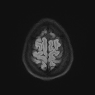 Cerebral cavernous venous malformation (Radiopaedia 70008-80021 Axial DWI 58).jpg