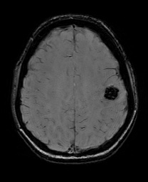 File:Cerebral cavernous venous malformation (Radiopaedia 70008-80021 I 53).jpg