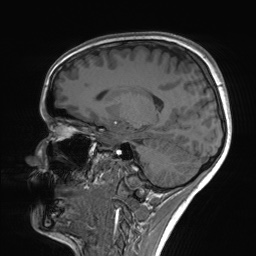 File:Cerebral cavernous venous malformation (Radiopaedia 70008-80021 Sagittal T1 46).jpg