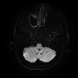 Cerebral cavernous venous malformation (Zabramski type II) (Radiopaedia 85511-101198 Axial DWI 40).jpg