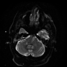 Cerebral embolic infarcts (embolic shower) (Radiopaedia 49837-55108 Axial DWI 37).jpg