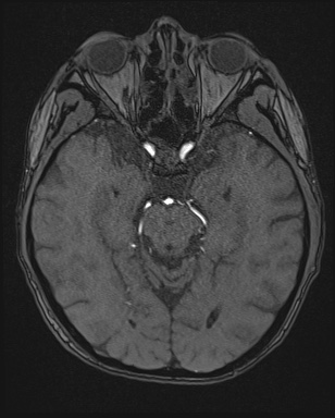 Cerebral embolic infarcts (embolic shower) (Radiopaedia 72391-82921 Axial MRA 58).jpg
