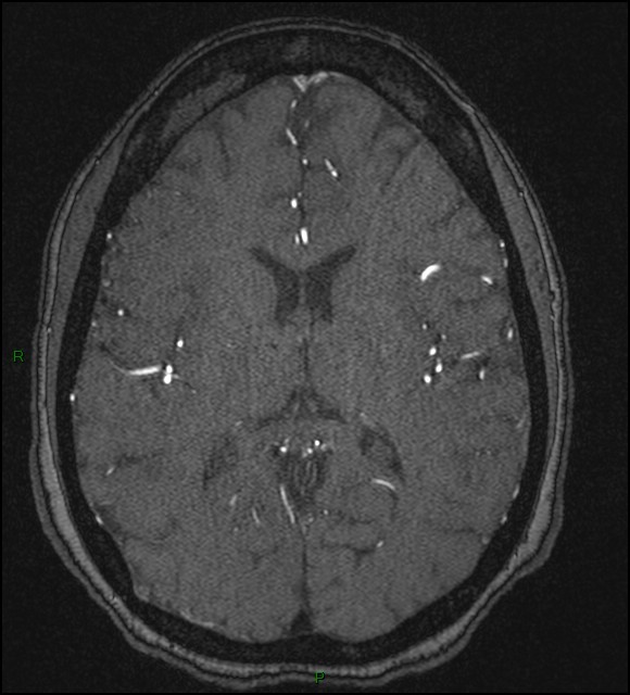 Cerebral fat embolism (Radiopaedia 35022-36525 Axial TOF 118).jpg