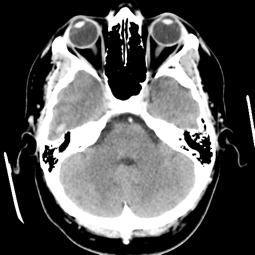 Cerebral hemorrhage secondary to arteriovenous malformation (Radiopaedia 33497-34561 B 15).png