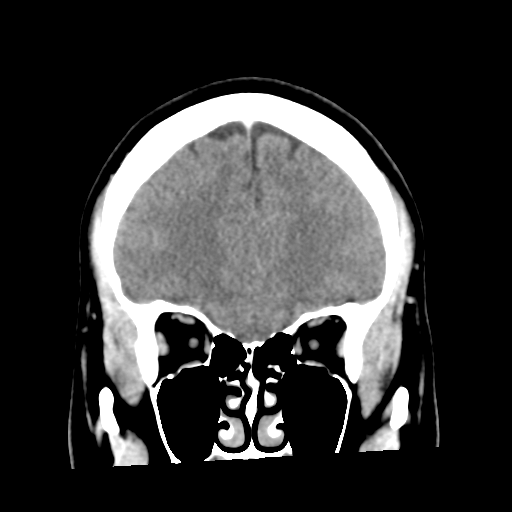 Cerebral hemorrhage secondary to arteriovenous malformation (Radiopaedia 33497-34561 C 17).png