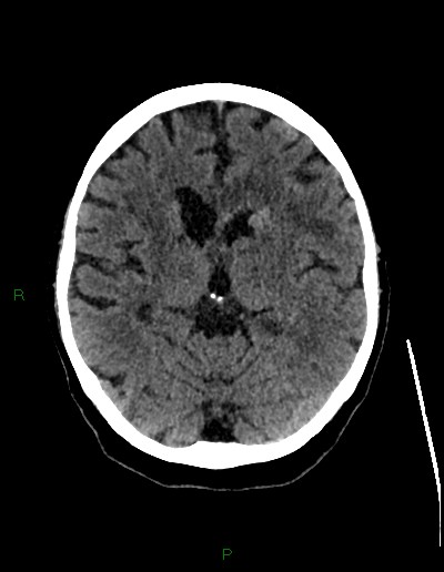 Cerebral metastases - ependymal and parenchymal (Radiopaedia 79877-93131 Axial non-contrast 36).jpg