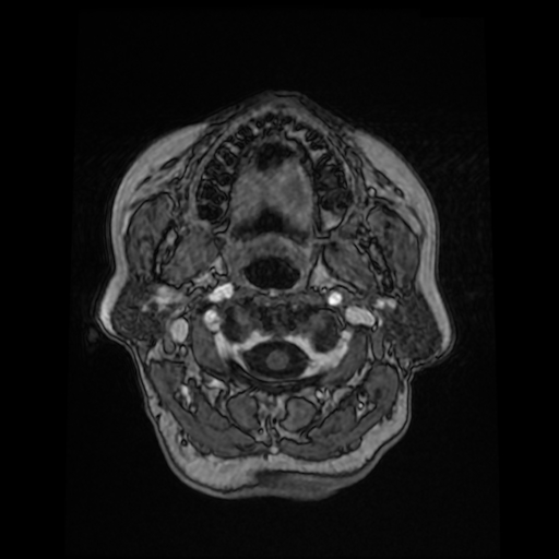 Cerebral metastases - melanoma (Radiopaedia 80972-94522 Axial T1 C+ 16).jpg