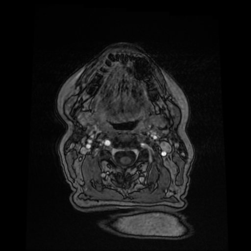File:Cerebral metastases - melanoma (Radiopaedia 80972-94522 Axial T1 C+ 5).jpg