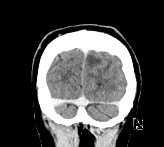 Cerebral metastases - testicular choriocarcinoma (Radiopaedia 84486-99855 D 56).jpg